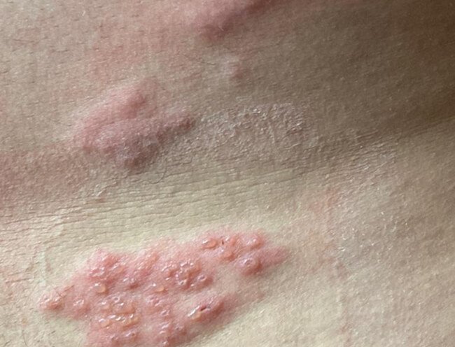 Virale Hauterkrankungen: HPV, Herpes