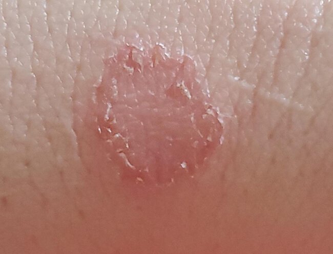Mykosen: Pilzinfektionen der Haut, Haare und Nägel