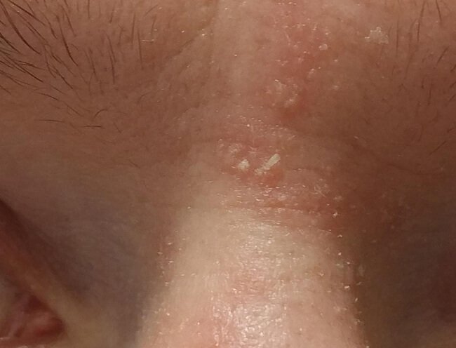 Papulosquamöse Erkrankungen: Psoriasis, Lichen