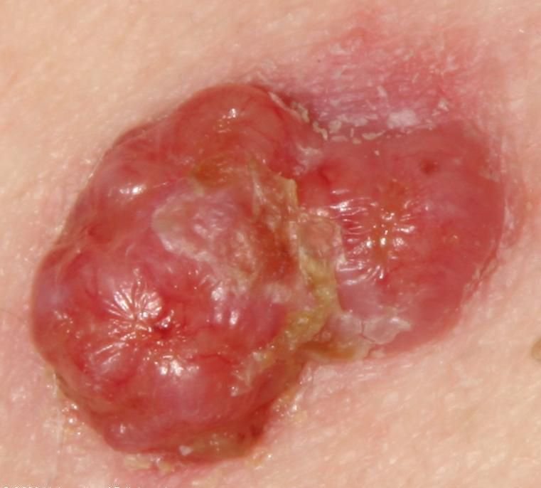 Basalzellkarzinom (ICD-10: C44) 🚨