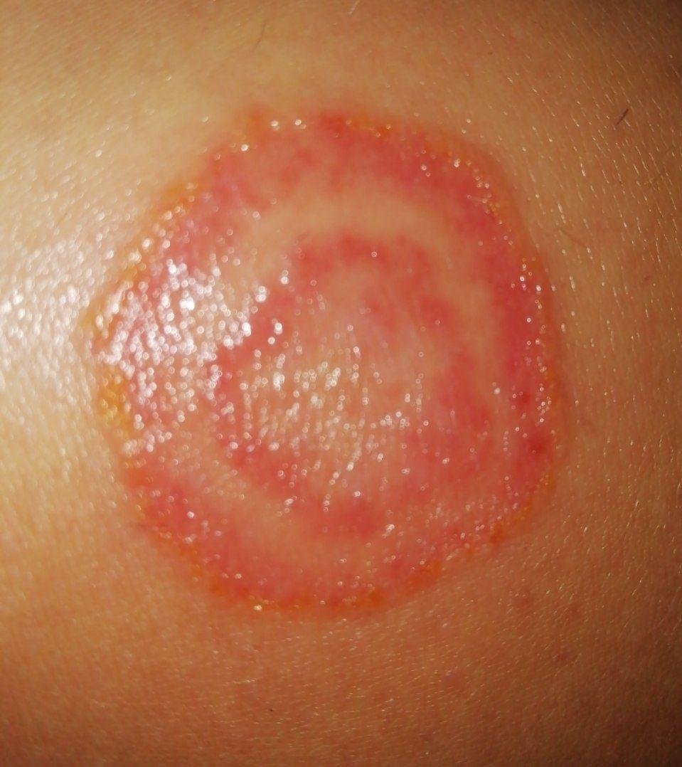 Micosis cutáneas (CIE-10: B35) 🚨