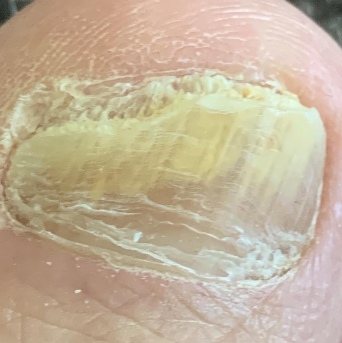 Onicomicosis (CIE-10: B35) 🚨