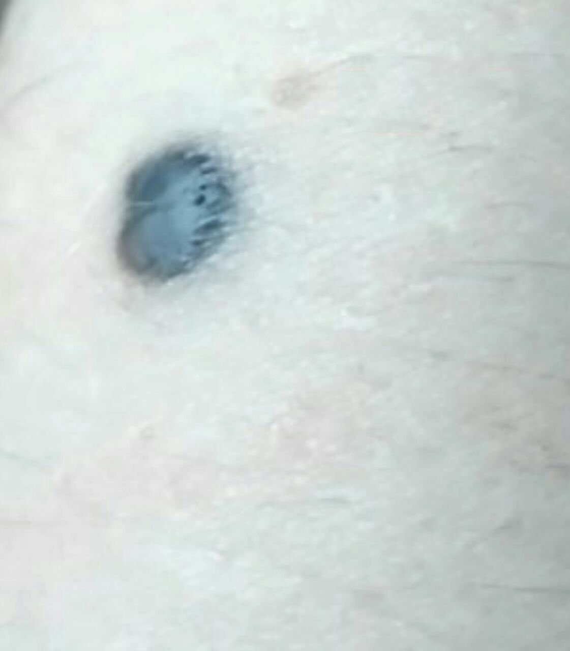 Blaues Nävus (ICD-10: D22) ⚠️