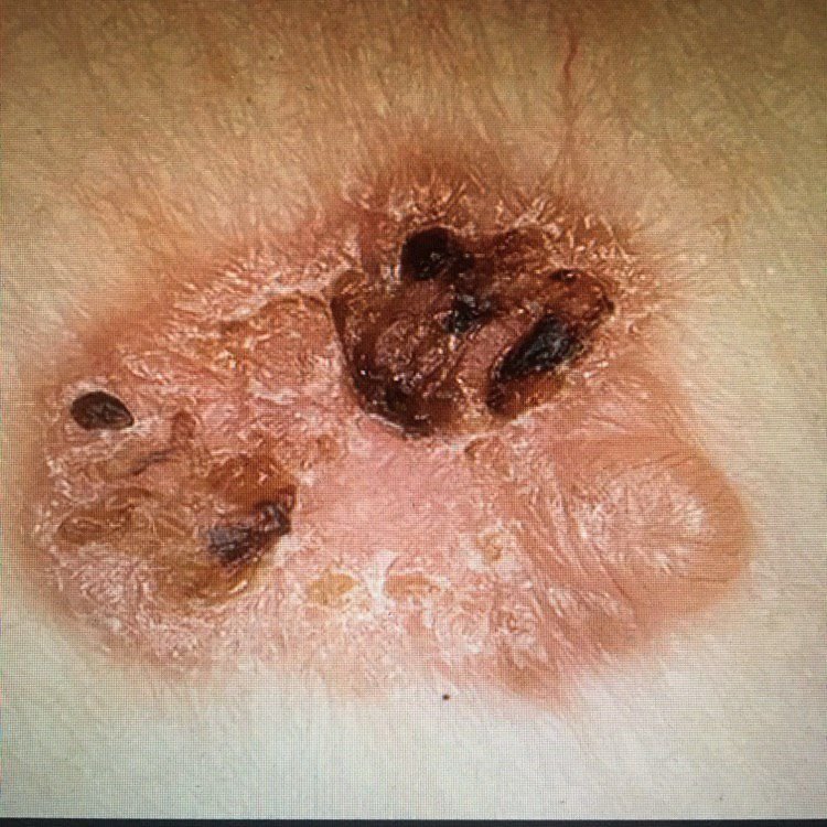 Plattenepithelkarzinom (ICD-10: C44) 🚨