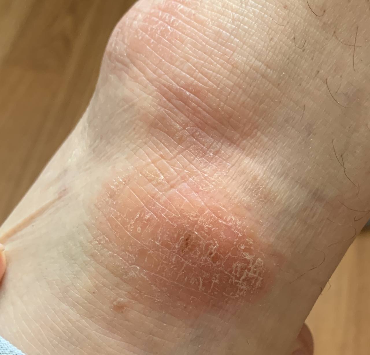 Atopische Dermatitis (ICD-10: L20) 🚨