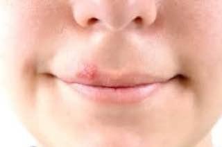Herpes Simplex (ICD-10: B00) ⚠️