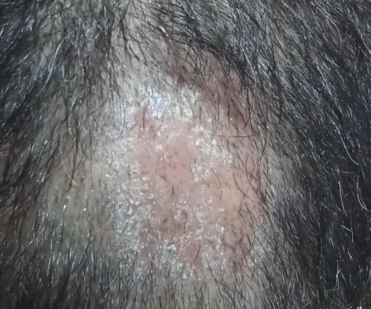 Tricomicosis (CIE-10: B35) 🚨