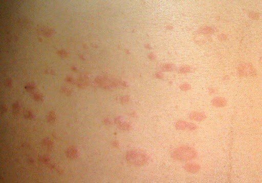 Pityriasis Rosea (ICD-10: L42) ⚠️