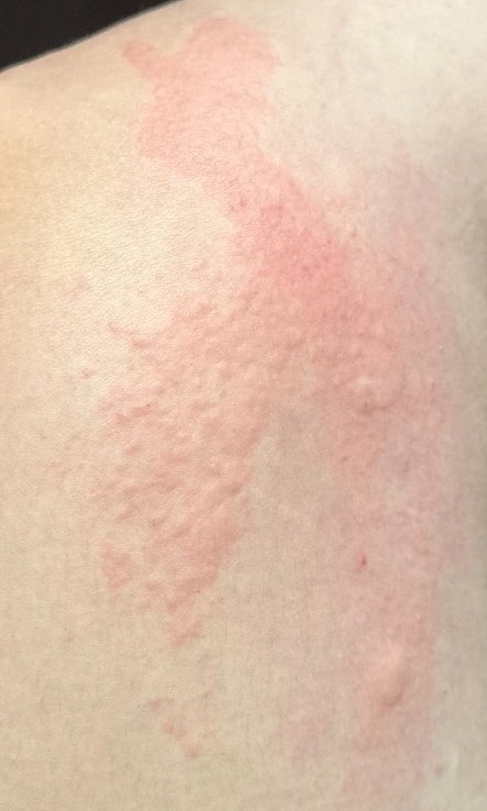 Allergische Urtikaria (ICD-10: L50) 🚨