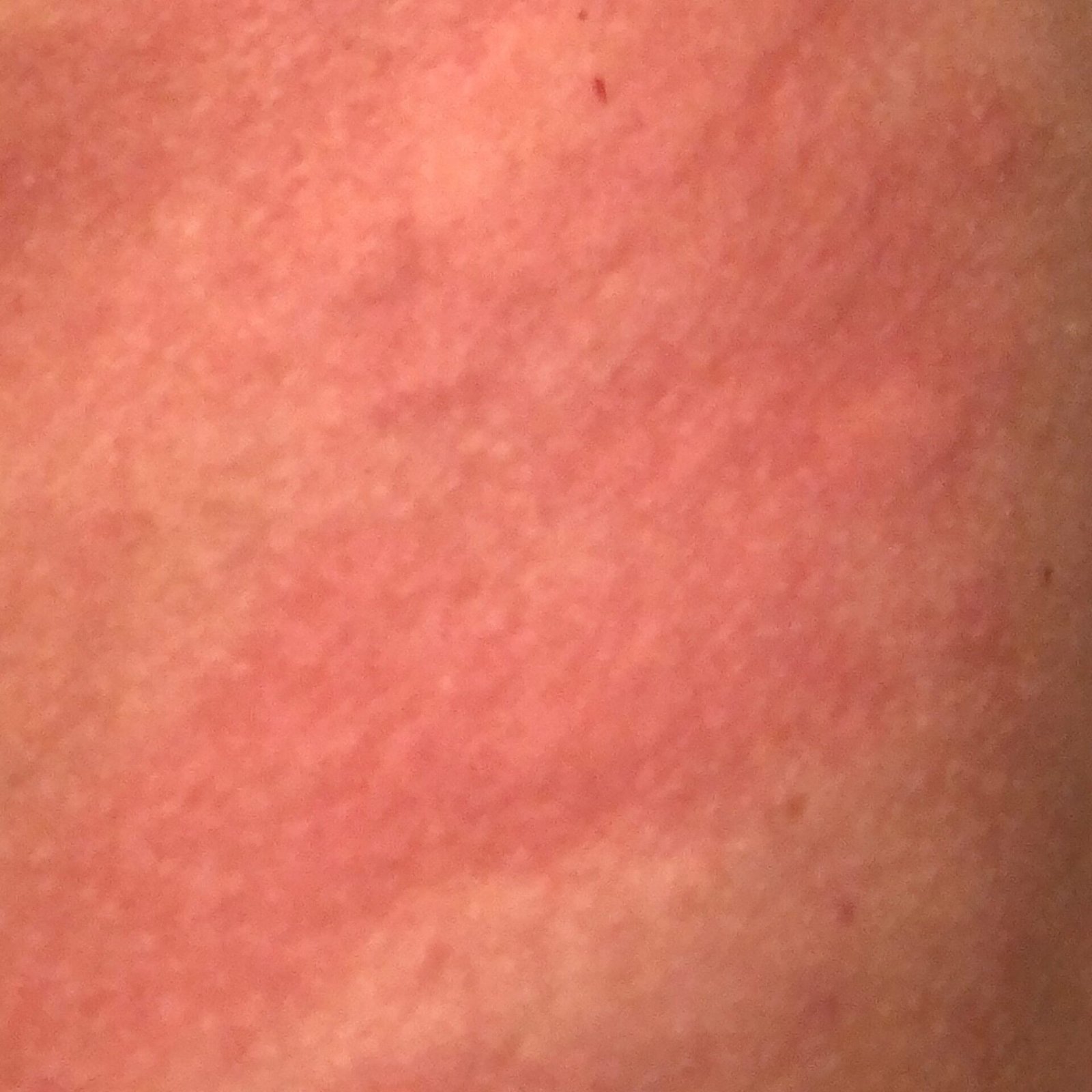 Dermatitis (ICD-10: L20) ⚠️