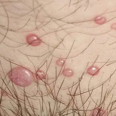Molluscum Contagiosum (ICD-10: B08) ⚠️