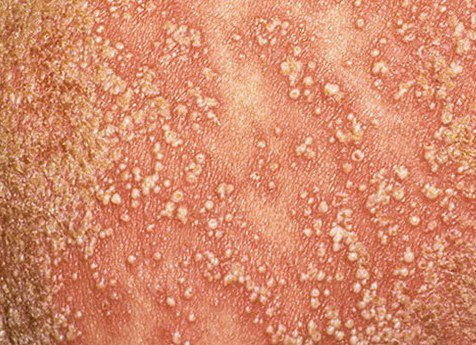 Psoriasis pustulosa (ICD-10: L40) 🚨