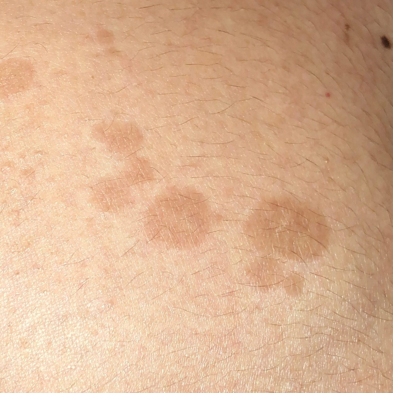 Pitiriasis versicolor (CIE-10: B36) ⚠️
