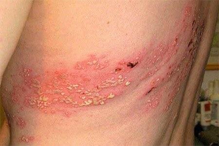 Herpes Zoster (ICD-10: B02) 🚨