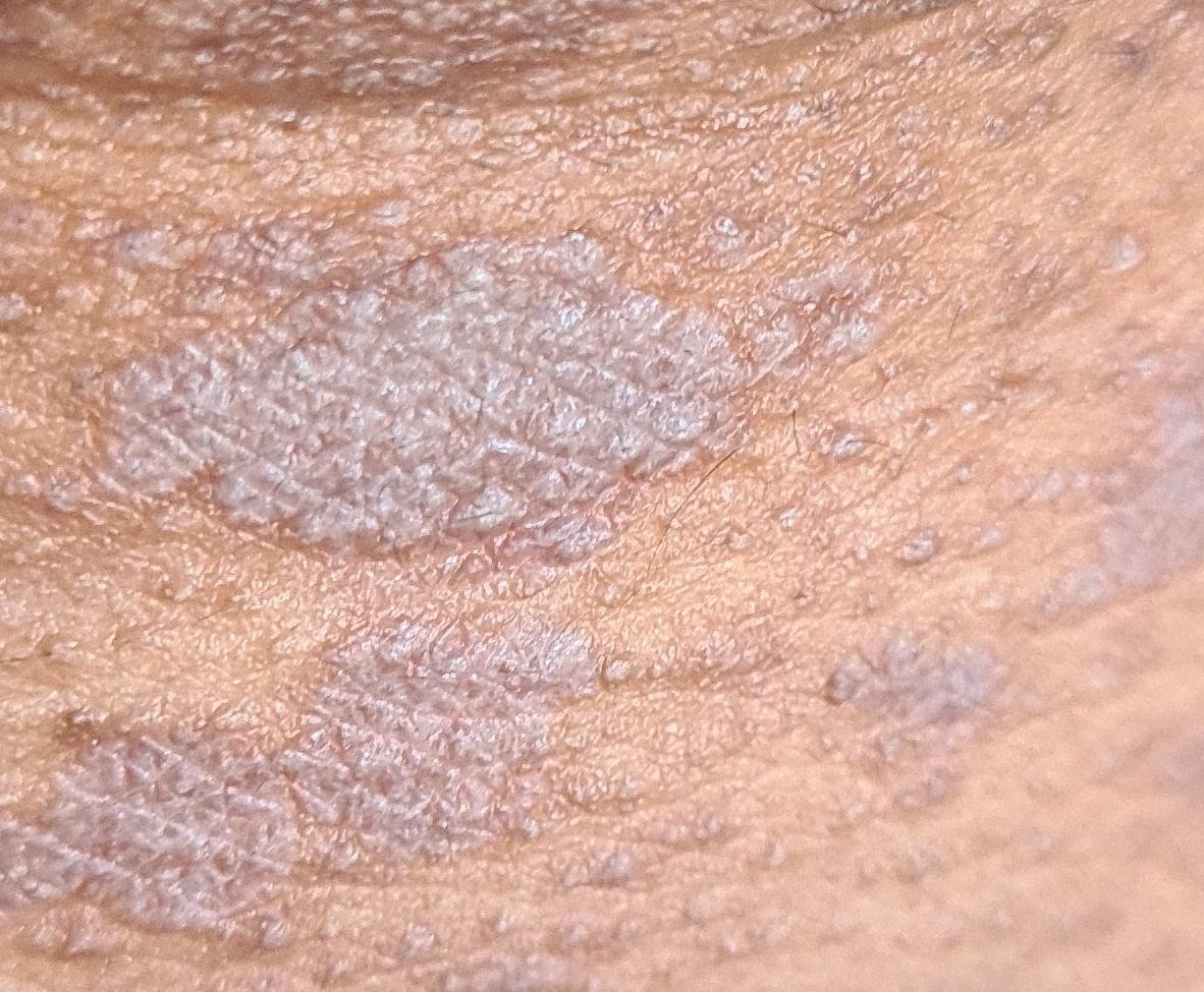 Lichen Planus (ICD-10: L43) ⚠️