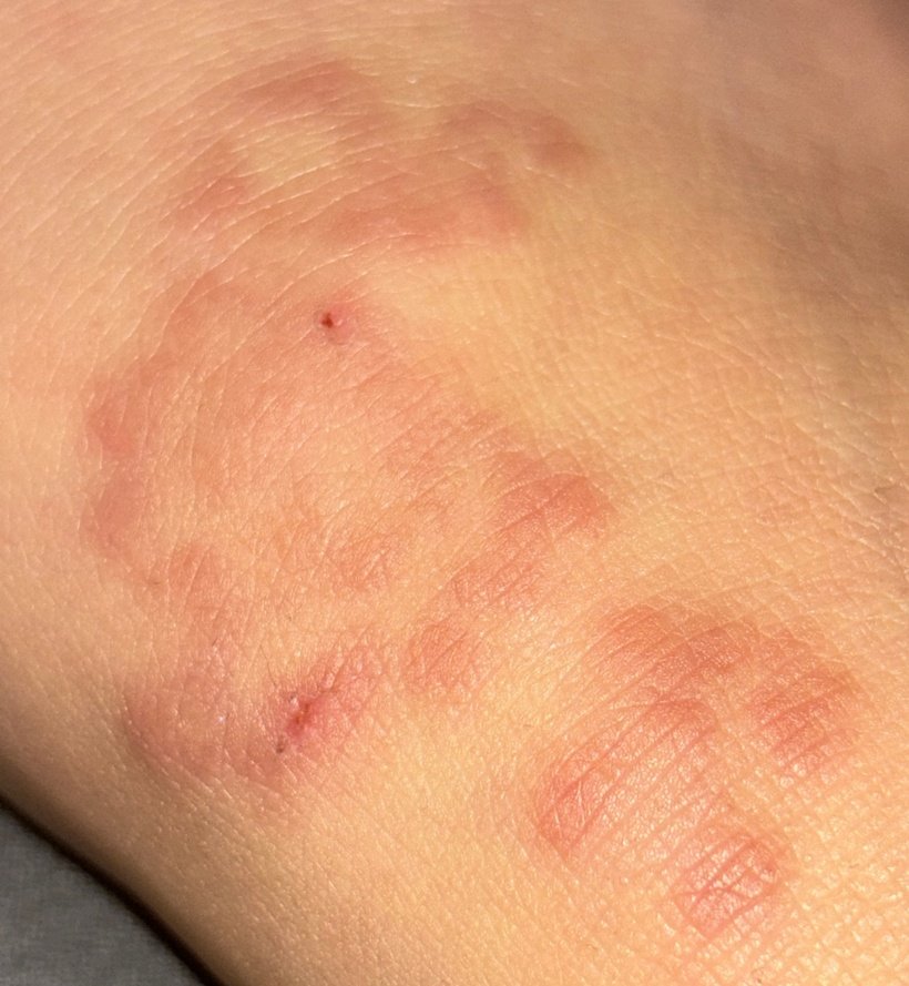 Ringförmiges zentrifugales Erythem(ICD-10: L53) ⚠️