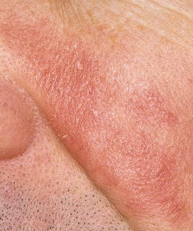 Seborrhoische Dermatitis (ICD-10: L21) ⚠️