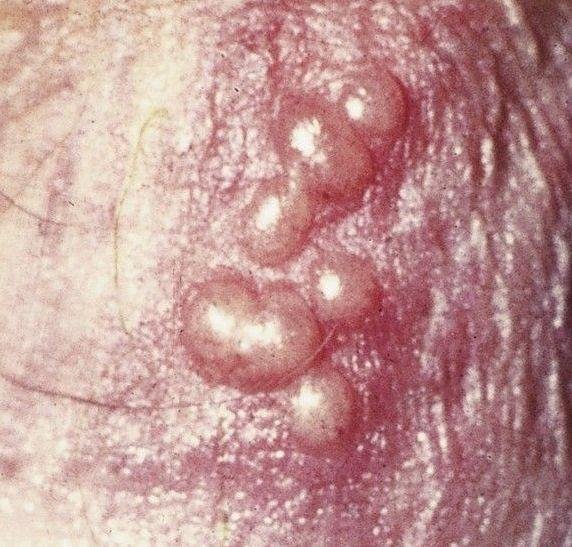 Herpes genitalis (ICD-10: A60) 🚨