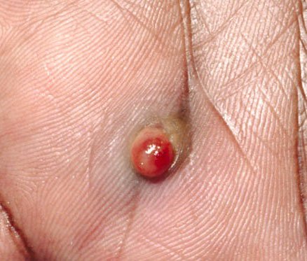 Pyogenes Granulom (ICD-10: L98) ⚠️