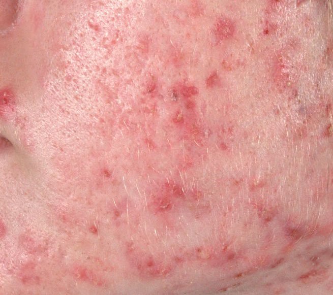 Akne vulgaris (ICD-10: L70) ⚠️