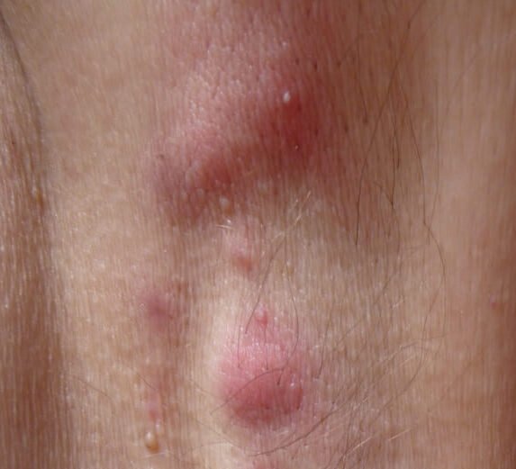 Inflamed nodules of hidradenitis suppurativa in a skin fold